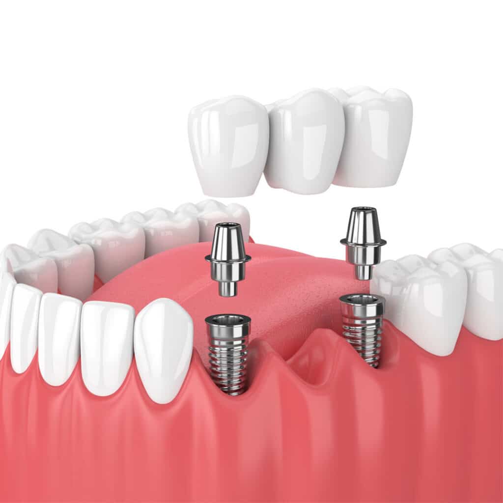 illustration of a dental implant bridge