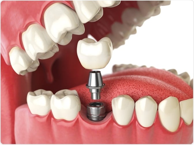 single dental implant illustration