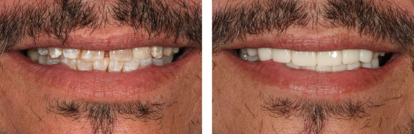 Worn-or-Chipped-Enamel